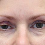 Ptosis Surgery Before & After Patient #1251