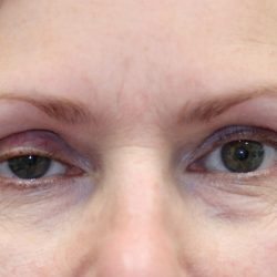 Ptosis Surgery Before & After Patient #1251