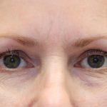 Ptosis Surgery Before & After Patient #1251
