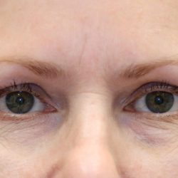 Ptosis Surgery Before & After Patient #1251
