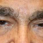 Ptosis Surgery Before & After Patient #1252