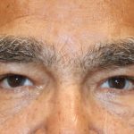 Ptosis Surgery Before & After Patient #1252