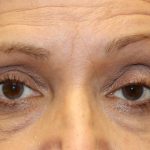 Ptosis Surgery Before & After Patient #1254