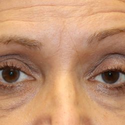 Ptosis Surgery Before & After Patient #1254