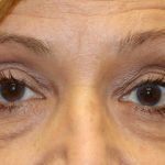 Ptosis Surgery Before & After Patient #1254