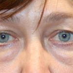 Lower Blepharoplasty Before & After Patient #1269