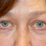 Lower Blepharoplasty Before & After Patient #1269