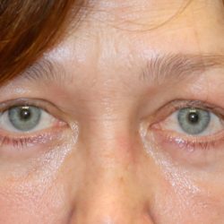 Lower Blepharoplasty Before & After Patient #1269