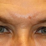 Upper Blepharoplasty Before & After Patient #1283