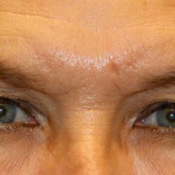 Upper Blepharoplasty Before & After Patient #1283