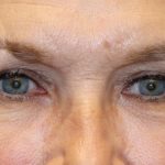 Upper Blepharoplasty Before & After Patient #1283