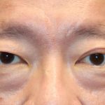 Upper Blepharoplasty Before & After Patient #1284