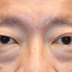 Upper Blepharoplasty Before & After Patient #1284