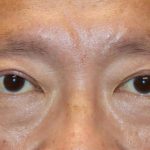 Upper Blepharoplasty Before & After Patient #1284