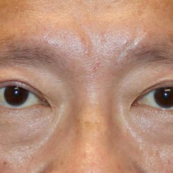 Upper Blepharoplasty Before & After Patient #1284
