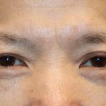 Upper Blepharoplasty Before & After Patient #1285
