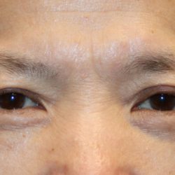Upper Blepharoplasty Before & After Patient #1285