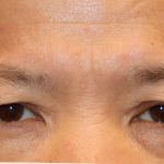 Upper Blepharoplasty Before & After Patient #1285
