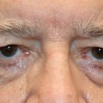 Brow Lift Before & After Patient #1287
