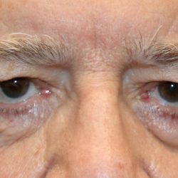 Brow Lift Before & After Patient #1287