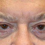Brow Lift Before & After Patient #1287