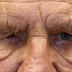 Brow Lift Before & After Patient #1286
