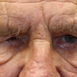 Brow Lift Before & After Patient #1286