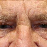 Brow Lift Before & After Patient #1286