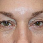 Ptosis Surgery Before & After Patient #1288