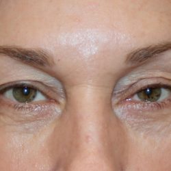 Ptosis Surgery Before & After Patient #1288