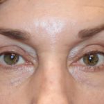 Ptosis Surgery Before & After Patient #1288