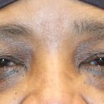 Ptosis Surgery Before & After Patient #1289
