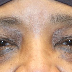 Ptosis Surgery Before & After Patient #1289