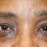 Ptosis Surgery Before & After Patient #1289