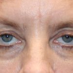 Ptosis Surgery Before & After Patient #1290