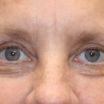 Ptosis Surgery Before & After Patient #1290
