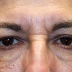 Brow Lift Before & After Patient #1291