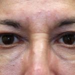 Brow Lift Before & After Patient #1291