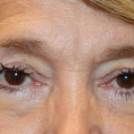 Lower Blepharoplasty Before & After Patient #1282
