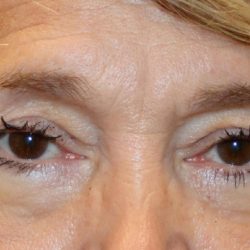 Lower Blepharoplasty Before & After Patient #1282
