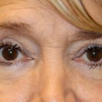 Lower Blepharoplasty Before & After Patient #1282