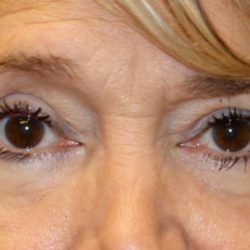 Lower Blepharoplasty Before & After Patient #1282