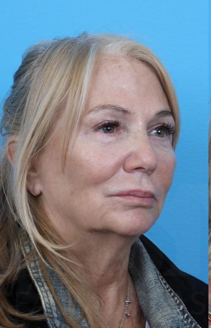 Facelift Before & After Patient #960