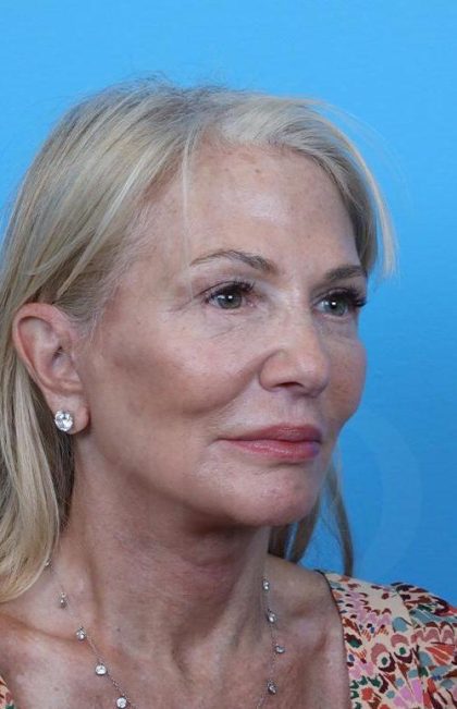 Facelift Before & After Patient #960