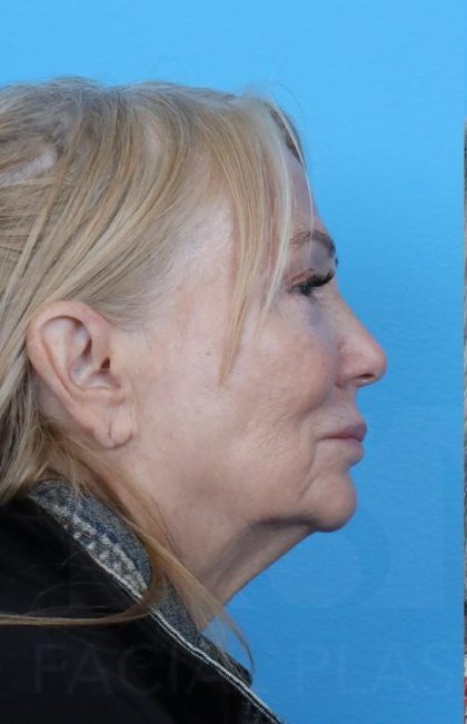 Facelift Before & After Patient #960