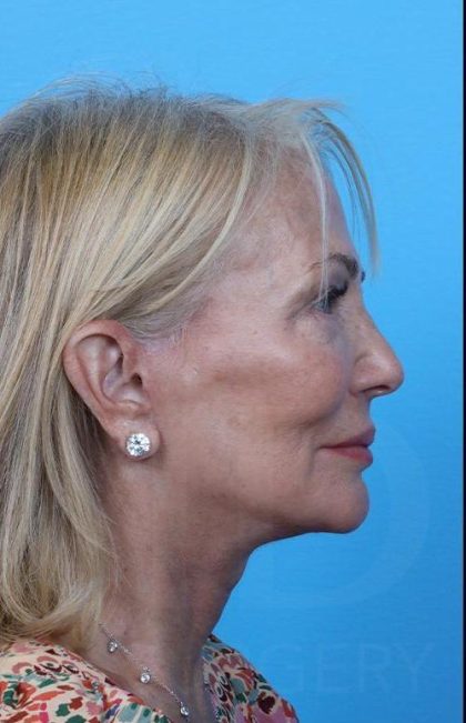 Facelift Before & After Patient #960