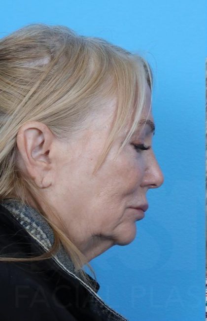 Facelift Before & After Patient #960