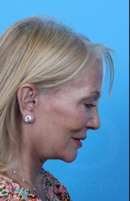 Facelift Before & After Patient #960