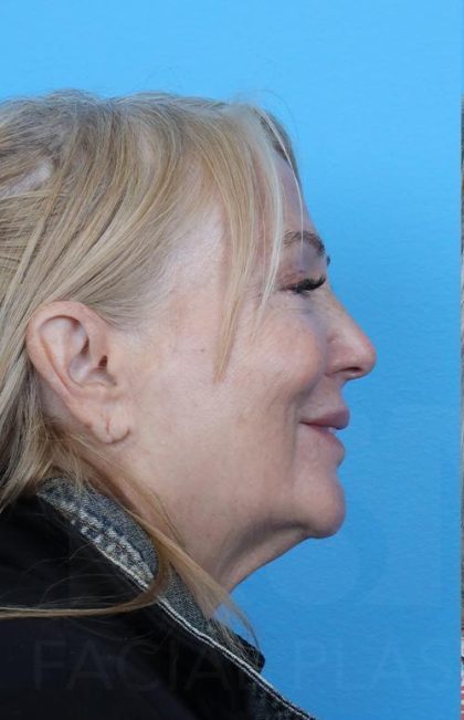 Facelift Before & After Patient #960