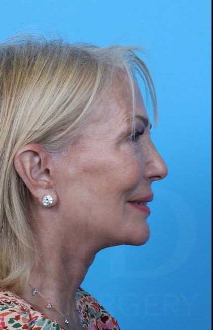 Facelift Before & After Patient #960